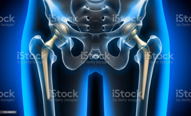 top best hospitals for hip replacement in the usa